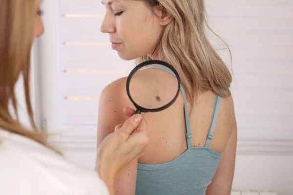 What Are Traditional Skin Lesion Removal Methods Owsestry?