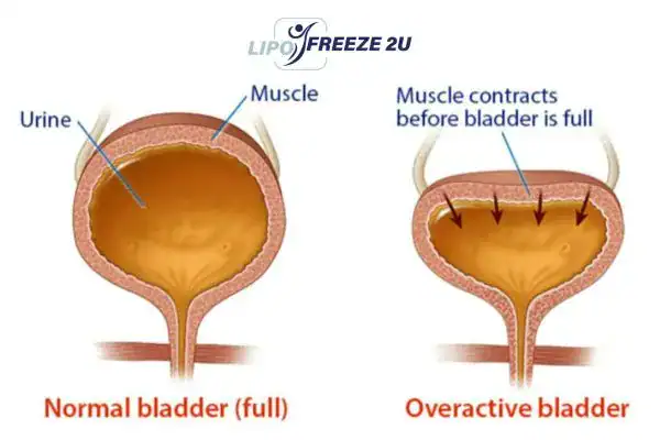 diagram of overactive bladder treatment Owsestry