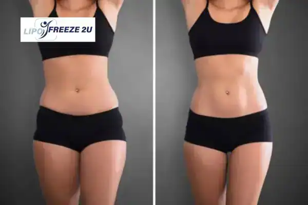 How Can LIPO FREEZE 2U Support Your Post-Pregnancy Body Recovery Owsestry?