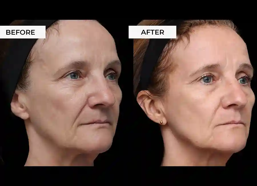 How Many RF Microneedling Sessions Will You Need to See a Difference Owsestry?