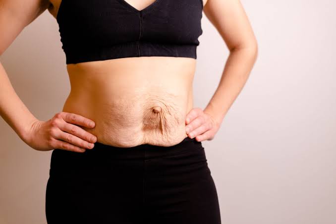Is Surgery Really the Only Way to Repair Diastasis Recti Owsestry?
