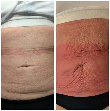 How Does RF Microneedling Improve Crepey, Thin and Uneven Skin Texture Owsestry?