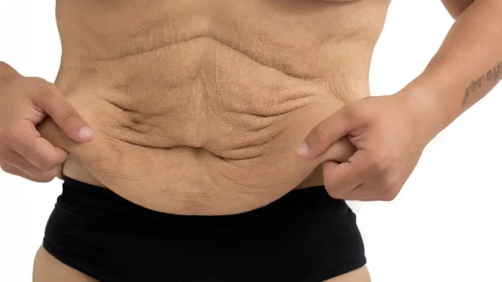 Why Does Weight Loss Medication Leave Some People With Loose or Sagging Skin Owsestry?